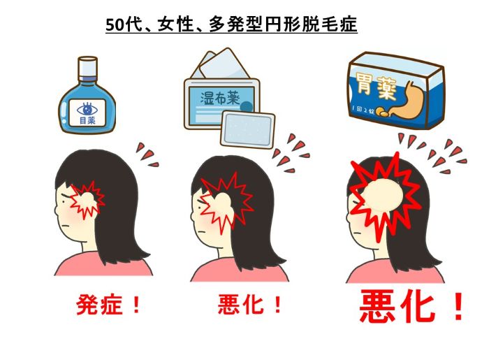 円形脱毛症　病院